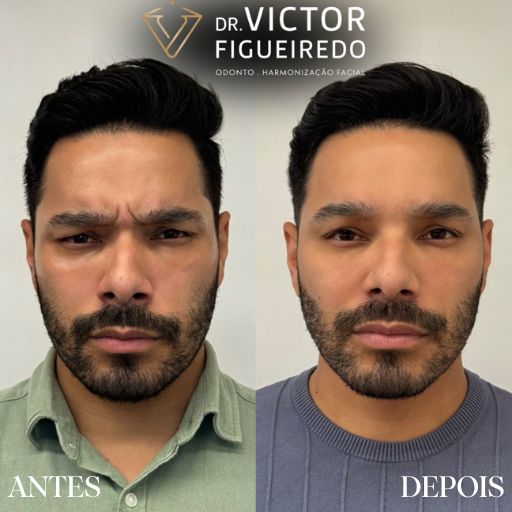 Botox (2)