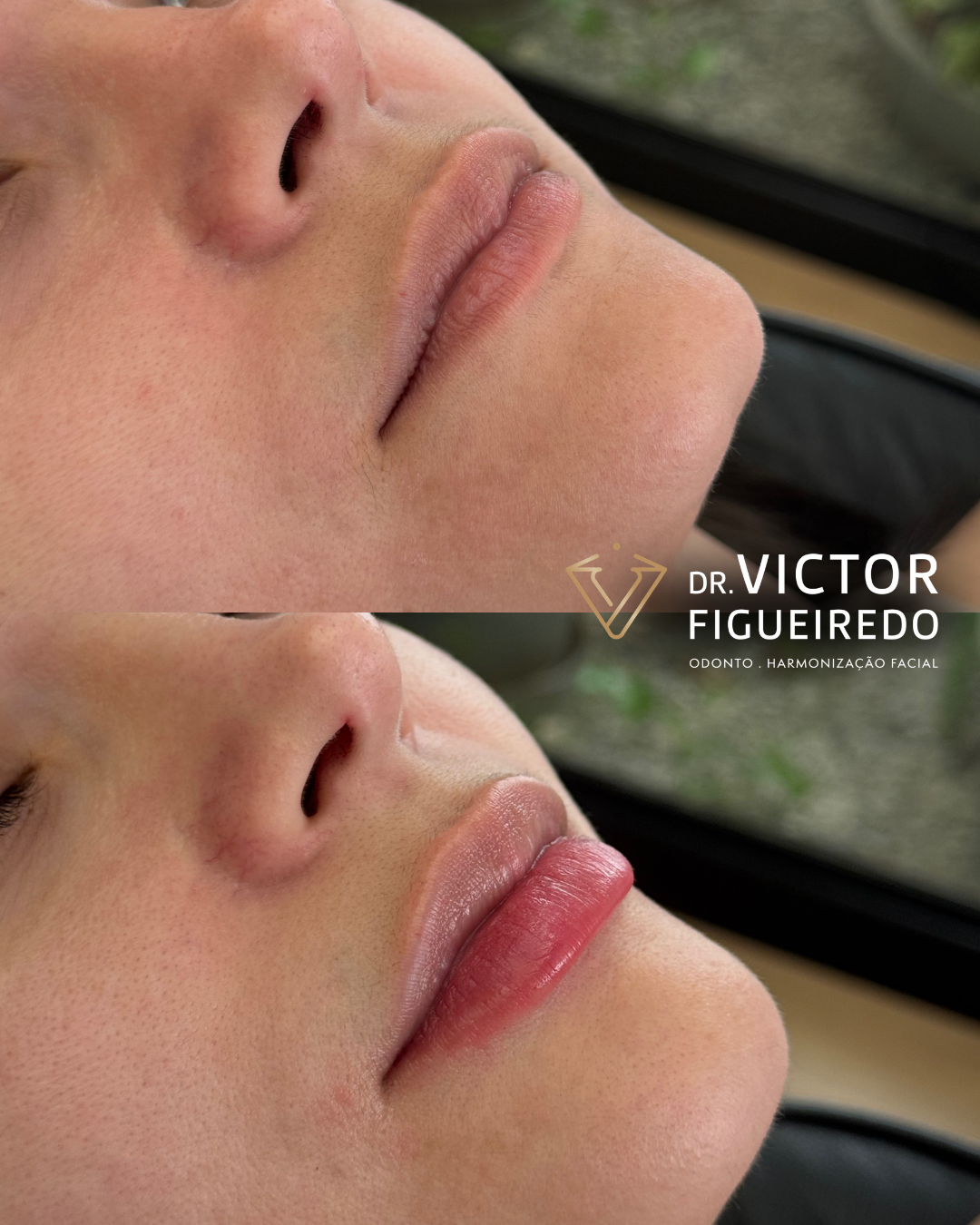 Dr. Victor Figueiredo. Preenchimento Labial #2.1