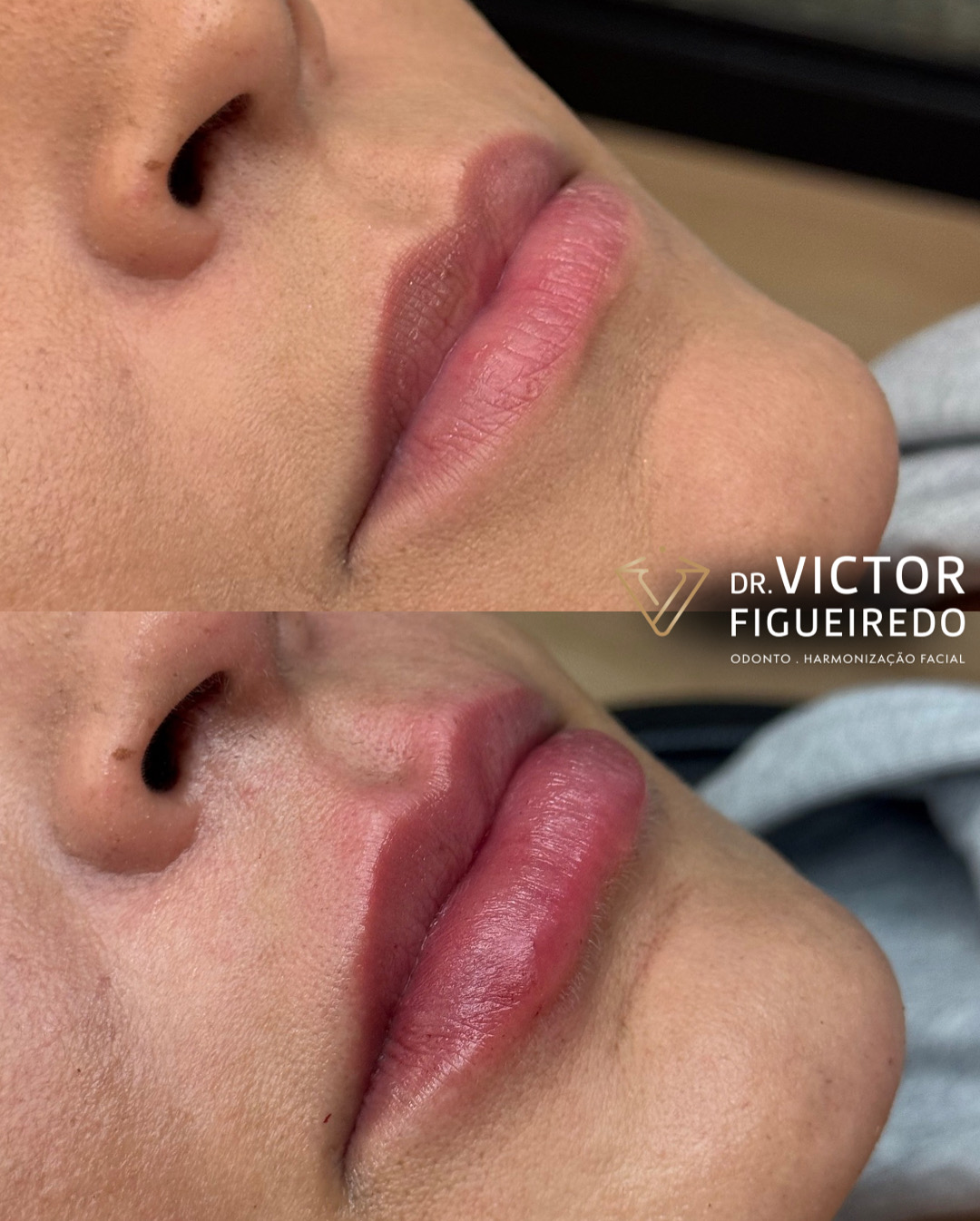 Dr. Victor Figueiredo. Preenchimento Labial #3.1