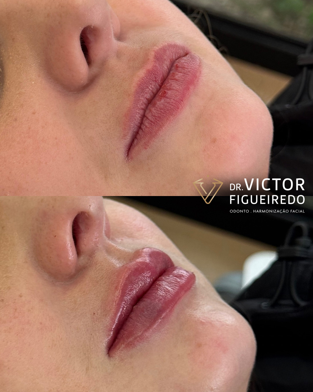 Dr. Victor Figueiredo. Preenchimento Labial #4.1