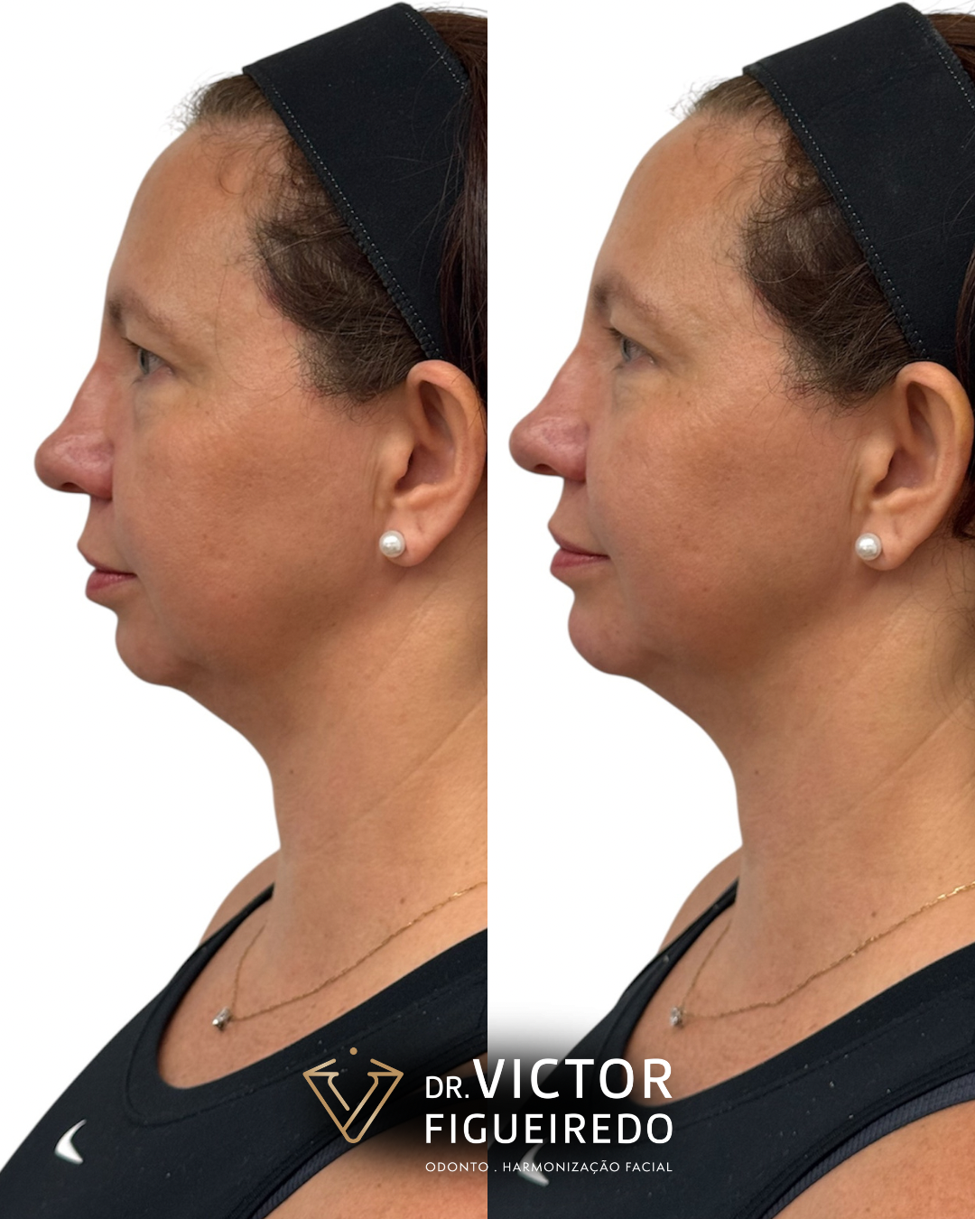 Dr. Victor Figueiredo. Preenchimento Facial #1.1