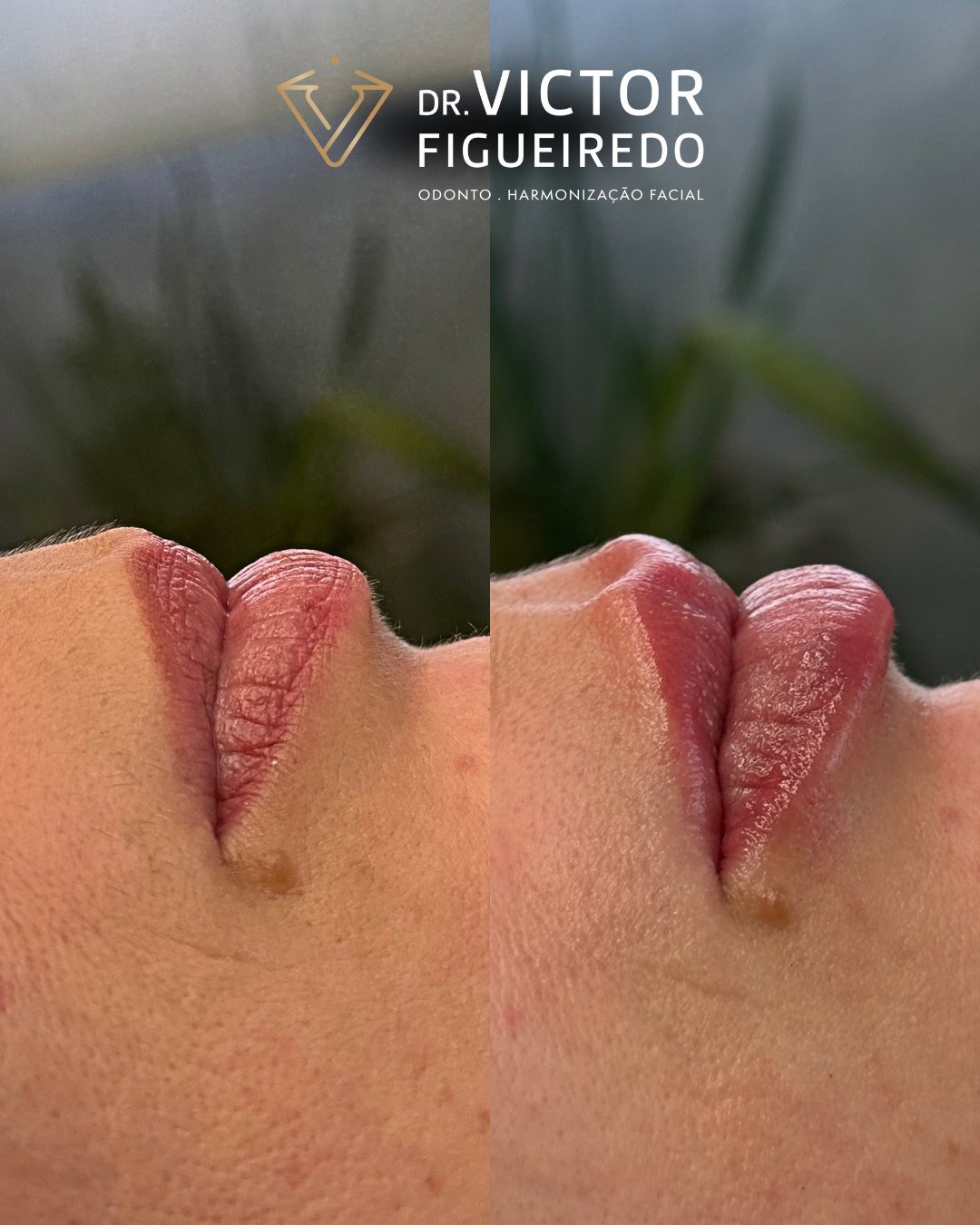 Dr. Victor Figueiredo. Preenchimento Labial #5.1