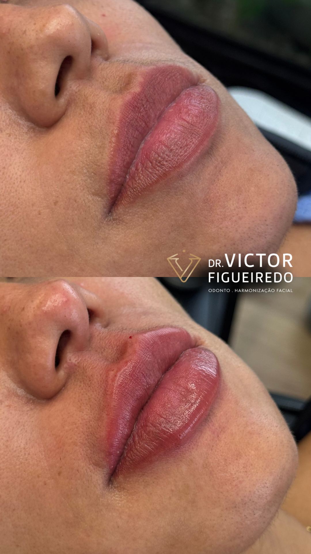 Dr. Victor Figueiredo. Preenchimento Labial #6.1