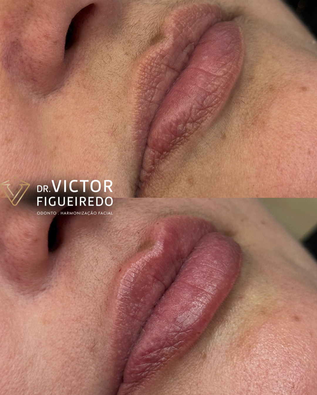 Dr. Victor Figueiredo. Preenchimento Labial #7.1